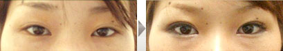 二重瞼の形成-瞼板法